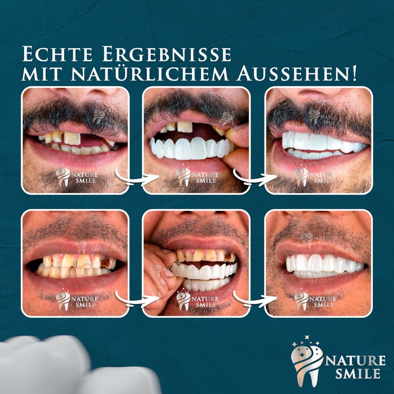 Nature Smile® – Abnehmbare Zahnveneers (KAUFE 1 PAAR UND ERHALTE EIN WEITERES GRATIS)